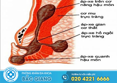 Giải đáp bệnh apxe hậu môn là gì?