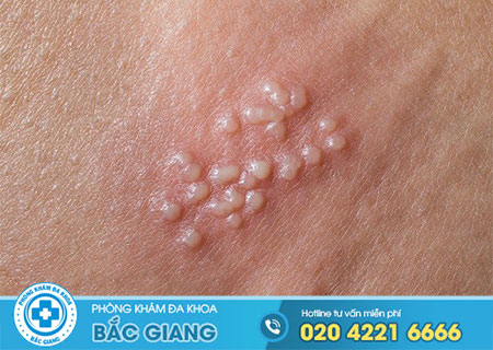 Bệnh mụn rộp sinh dục là gì