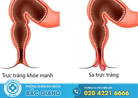 Giải đáp bệnh sa trực tràng là gì?