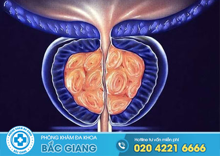Bệnh tăng sinh tuyến tiền liệt là gì?