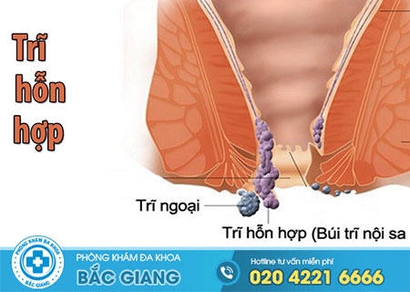 Chuyên gia giải đáp bệnh trĩ hỗn hợp là gì?