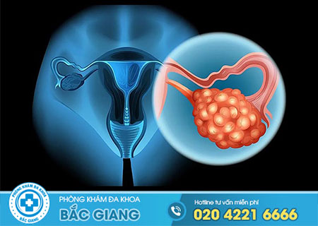 Một số kiến thức giải đáp bệnh u nang buồng trứng là gì