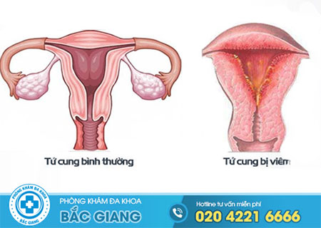 Tìm hiểu bệnh viêm nội mạc tử cung là gì?