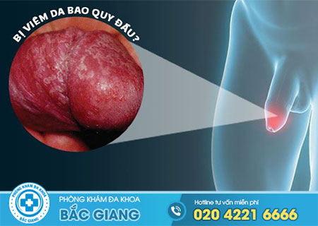Bệnh viêm quy đầu là gì?
