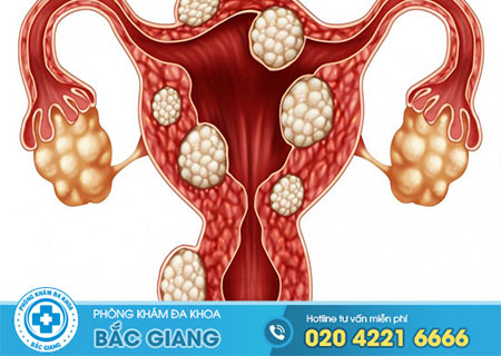 Biến chứng của u xơ tử cung