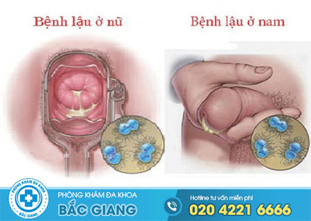 Tìm hiểu cách điều trị bệnh lậu an toàn và hiệu quả