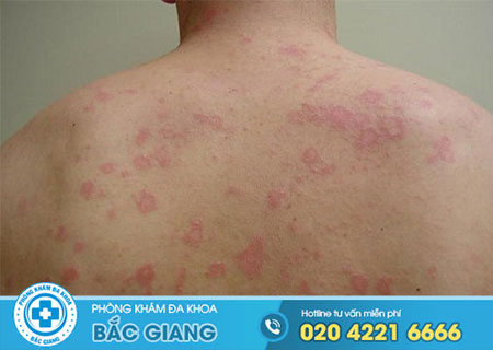 Dấu hiệu của bệnh giang mai là gì?