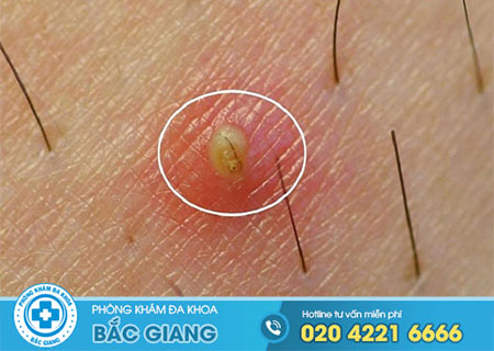 Mọc mụn vùng kín là bệnh như thế nào?