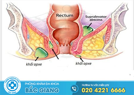 Nguyên nhân gây bệnh apxe hậu môn