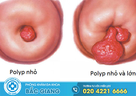 Nguyên nhân gây polyp cổ tử cung
