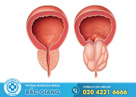 Nguyên nhân gây u nang tuyến tiền liệt