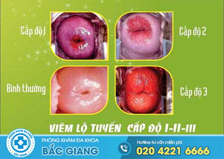 Nguyên nhân mắc viêm lộ tuyến cổ tử cung