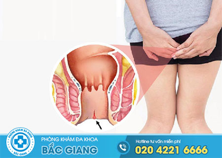 Nứt kẽ hậu môn là bệnh gì?