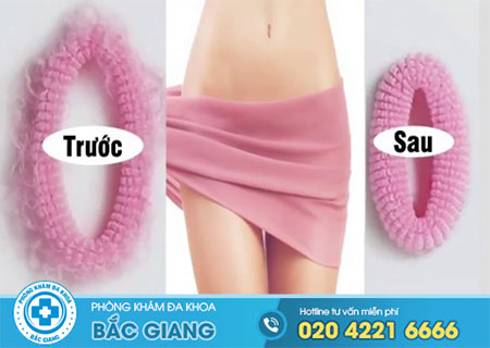 Phương pháp thu hẹp âm đạo tiên tiến hiện nay