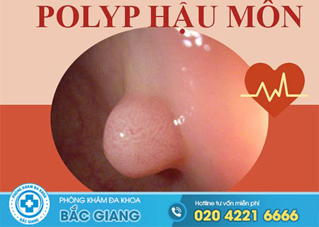 Tìm hiểu polyp hậu môn là bệnh gì để tránh hiểm họa khôn lường