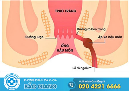 Rò rỉ hậu môn nỗi ám ảnh của không ít bệnh nhân