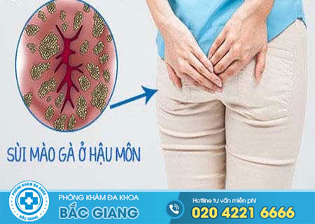 Sùi mào gà hậu môn