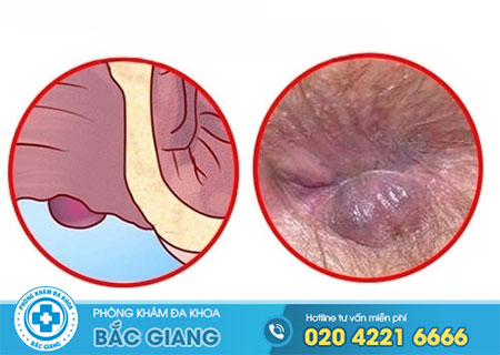 Tác hại của bệnh trĩ ngoại