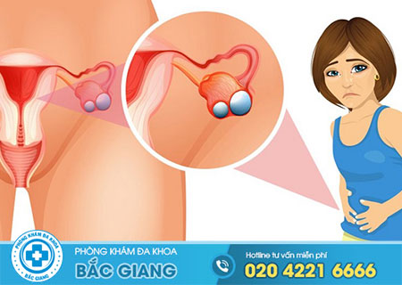 Tác hại của bệnh u nang buồng trứng và cách chữa trị