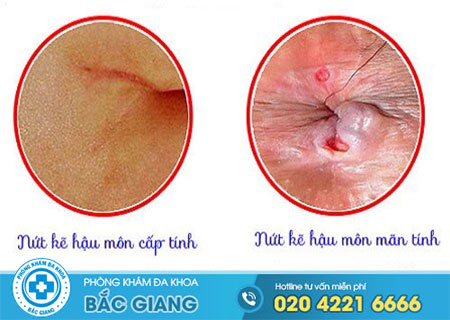 Tác hại của nứt kẽ hậu môn