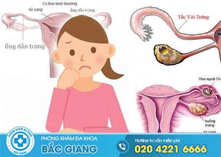 Tắc ống dẫn trứng là gì?