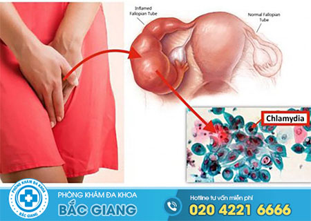 Tại sao bị chlamydia