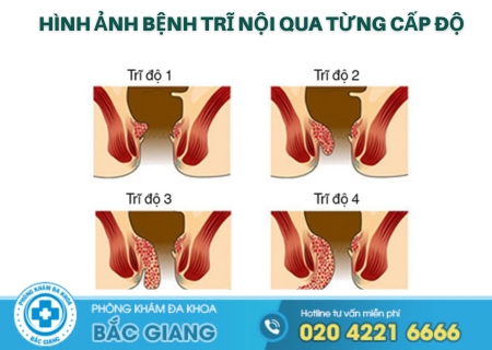 Nhận biết nguyên nhân gây bệnh trĩ nội để phòng tránh
