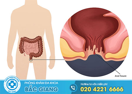 Những triệu chứng bệnh nứt kẽ hậu môn bạn cần biết