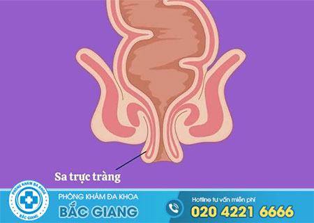 Triệu chứng bệnh sa trực tràng