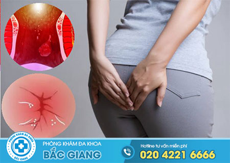Tự nhận biết triệu chứng bệnh trĩ hỗn hợp