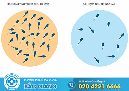 Triệu chứng của bệnh tinh trùng ít