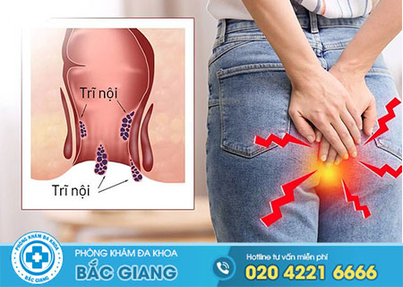 Tổng hợp triệu chứng của bệnh trĩ nội