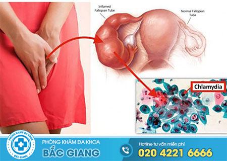 Triệu chứng mắc chlamydia