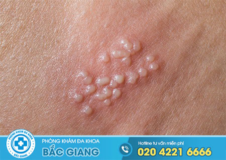 Triệu chứng mắc mụn rộp sinh dục