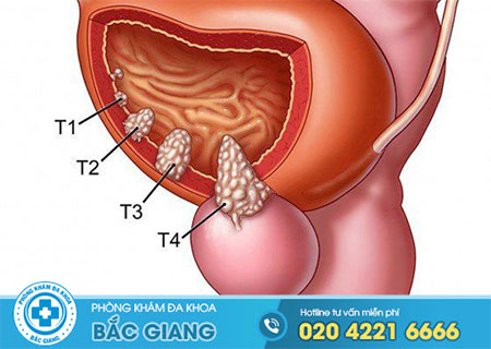 U nang tuyến tiền liệt có tác hại gì?