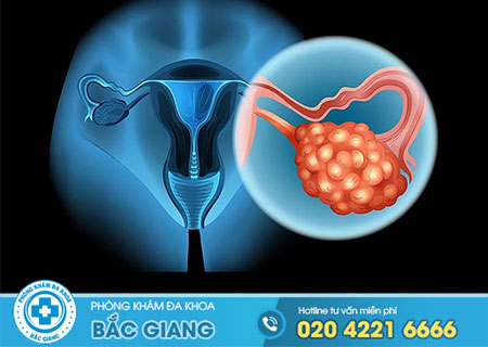 Giải đáp thắc mắc: Vì sao bị u nang buồng trứng?