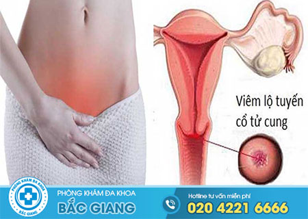 Viêm lộ tuyến độ 2