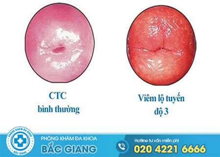 Viêm lộ tuyến độ 3