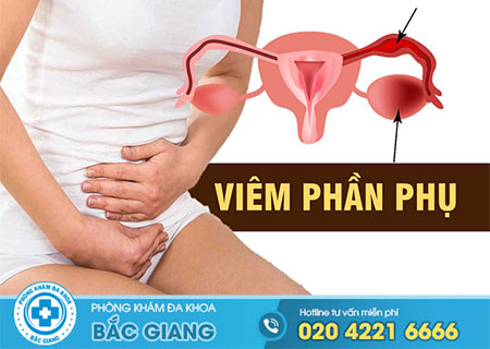 Viêm phần phụ là gì?