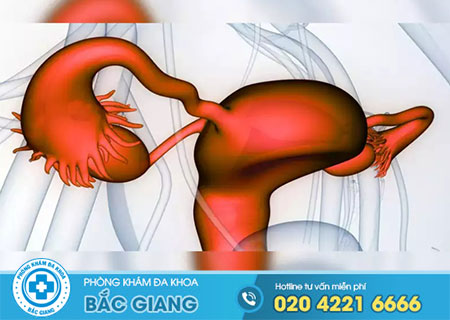 Bệnh buồng trứng đa nang là gì