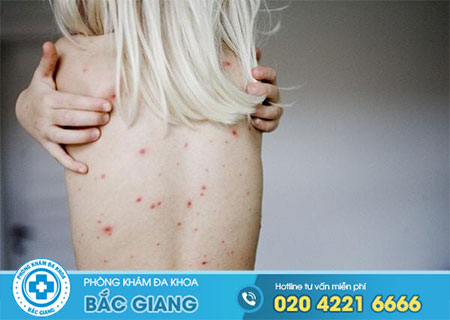 Tìm hiểu bệnh giang mai ở nữ giới