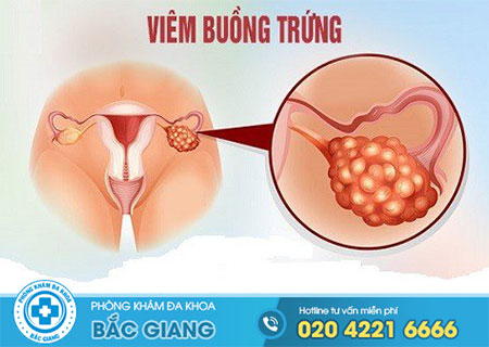 bệnh viêm buồng trứng là gì?