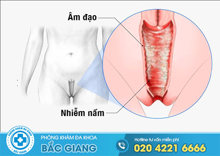 Bị nấm âm đạo và cách chữa hiệu quả