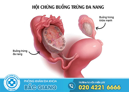 Biểu hiện bị buồng trứng đa nang