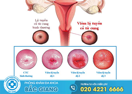 Các cấp độ của viêm lộ tuyến