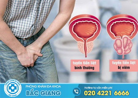 Cách điều trị viêm tuyến tiền liệt mãn tính không lo biến chứng