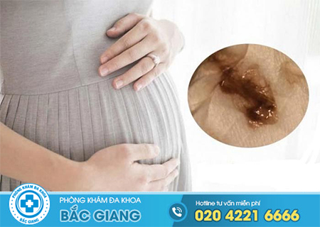 Có thai ra dịch màu nâu đen báo hiệu điều gì?