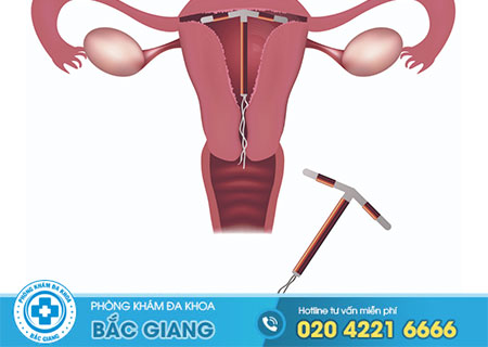 Tìm hiểu đặt vòng tránh thai là gì?
