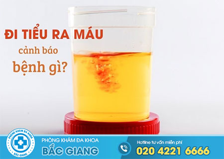 Đi tiểu ra máu: Hãy lập tức đi khám ngay