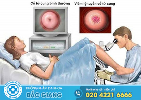 Đốt viêm lộ tuyến tử cung có đau không?